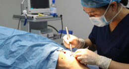 Not Ready for a Knee Replacement? A Minimally Invasive Procedure May Ease Chronic Pain Without Joint Replacement